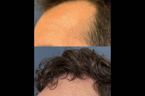 hair-restoration-2-1