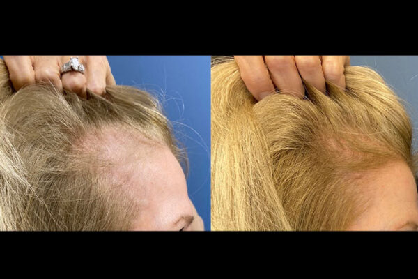 hair-restoration-6-2b