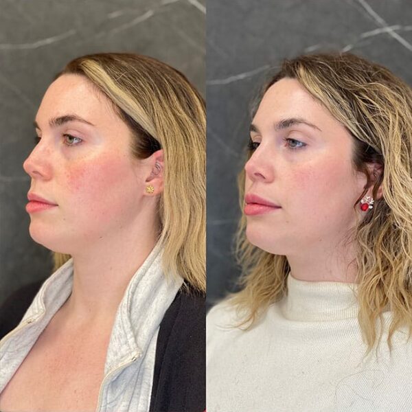 lip-filler-28a lip-filler-28a