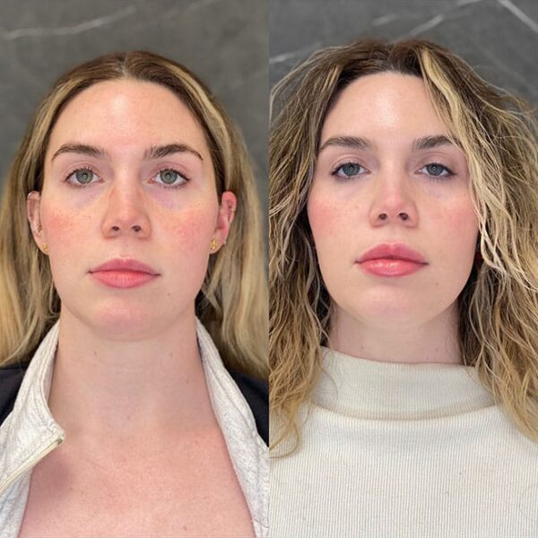 lip-filler-28c lip-filler-28c