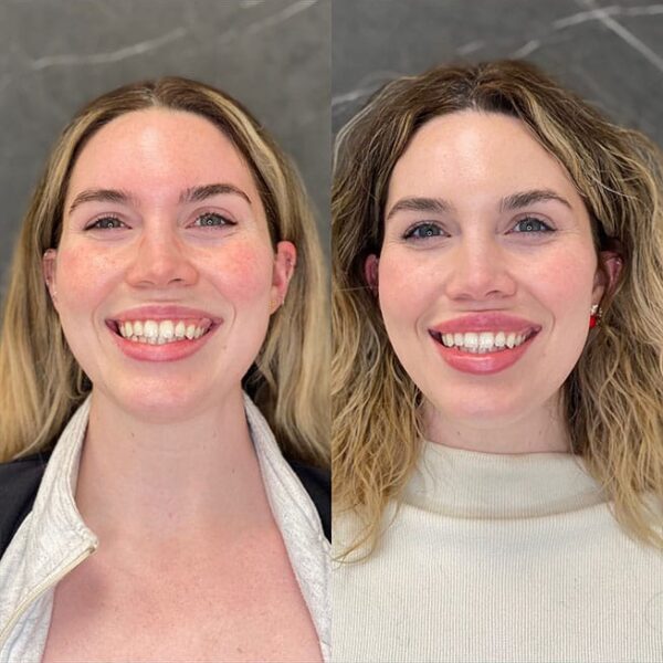 lip-filler-28d lip-filler-28d