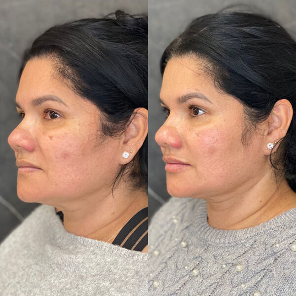 lip-filler-29a lip-filler-29a