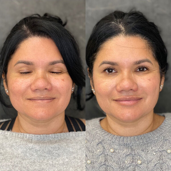 lip-filler-29c lip-filler-29c