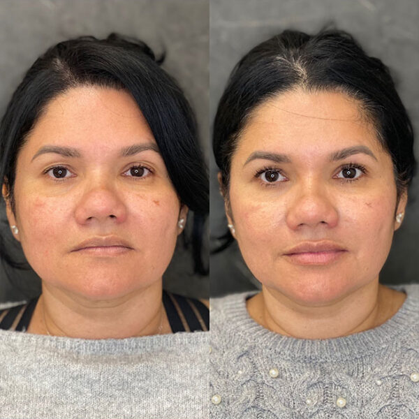 lip-filler-29d lip-filler-29d