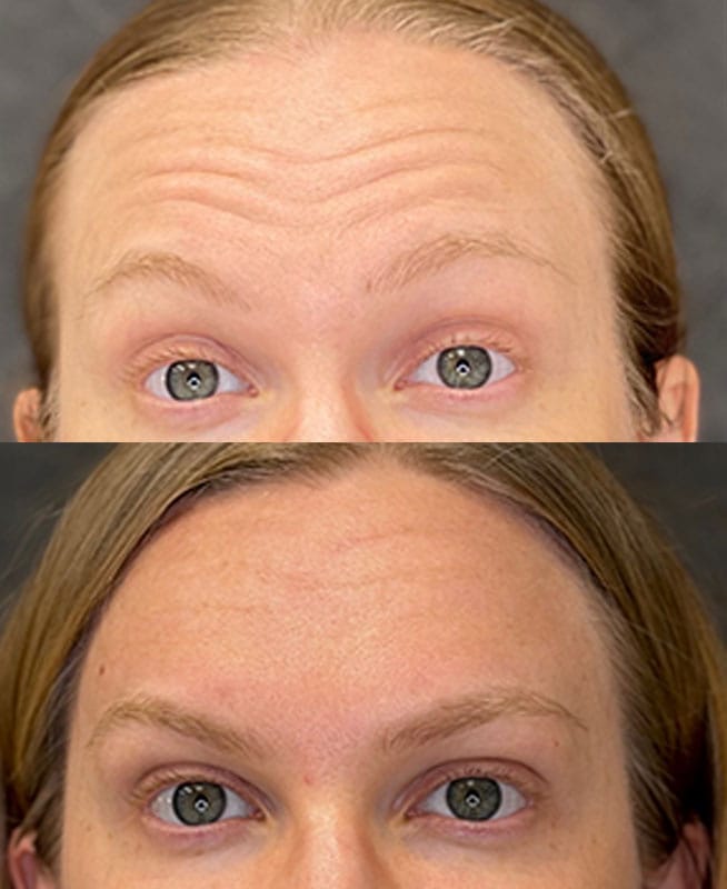 skinology-botox-ba-2.1