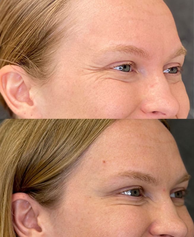 skinology-botox-ba-2.4