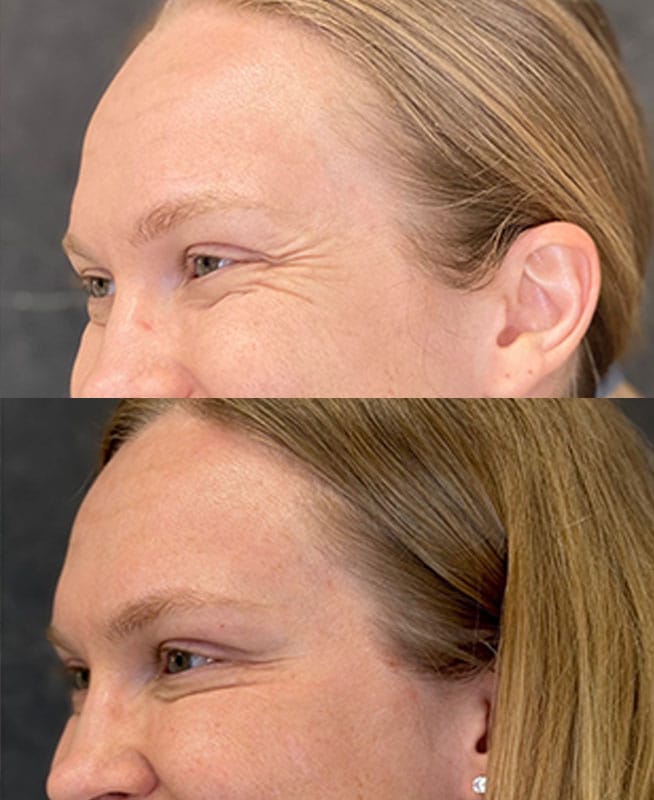 skinology-botox-ba-2.5