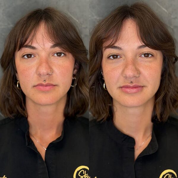 RHA filler patient 1 RHA filler patient 1