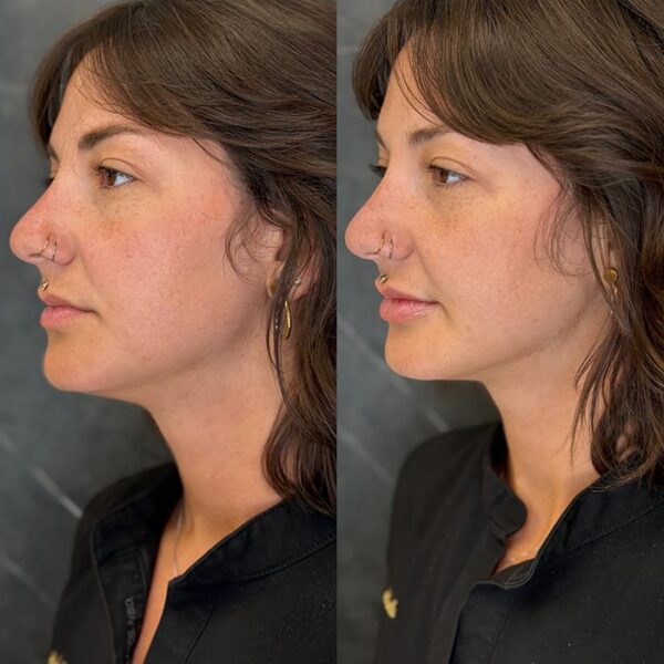 RHA filler patient 2 RHA filler patient 2