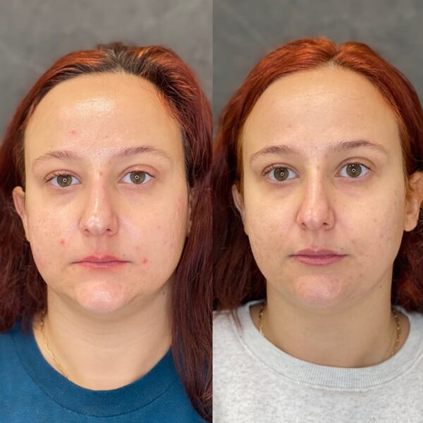RHA filler patient 21 RHA filler patient 21