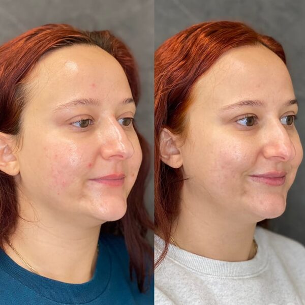 RHA filler patient 22 RHA filler patient 22
