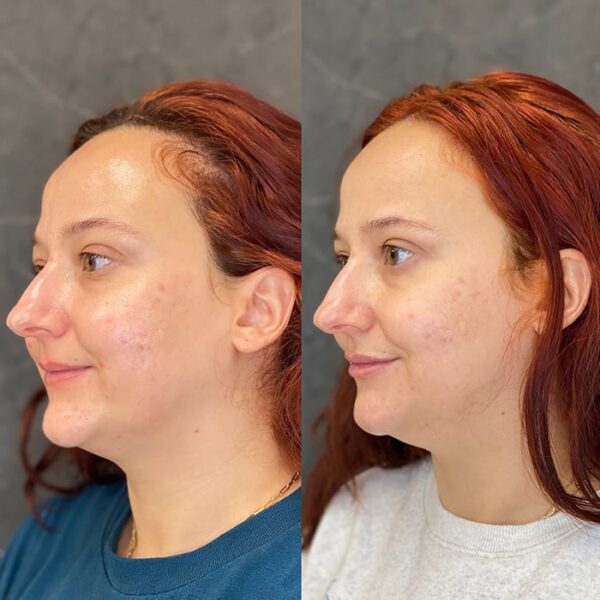 RHA filler patient 23 RHA filler patient 23