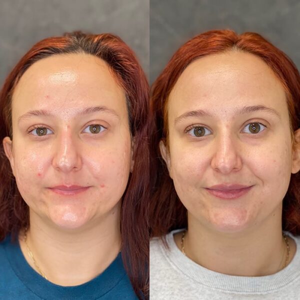 RHA filler patient 24 RHA filler patient 24