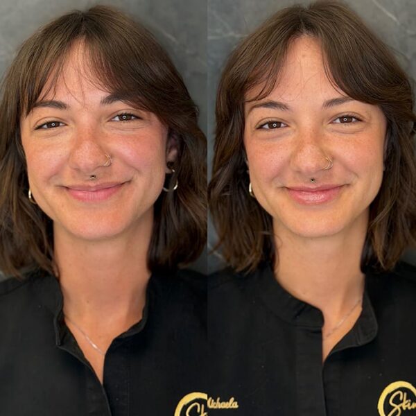 RHA filler patient 3 RHA filler patient 3