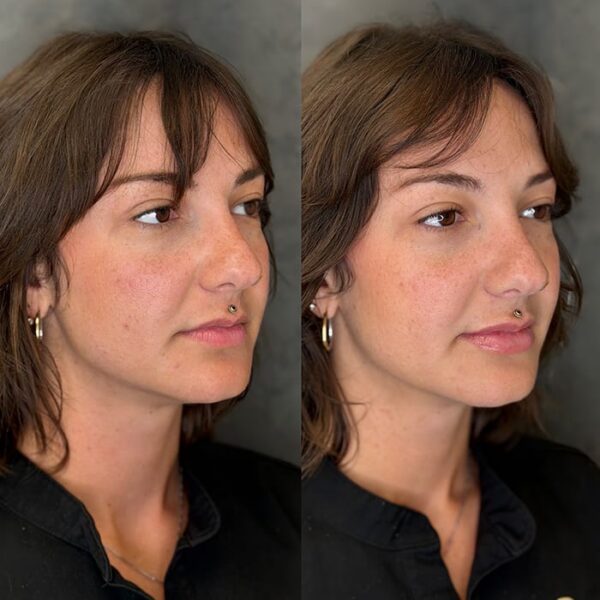 RHA filler patient 4 RHA filler patient 4