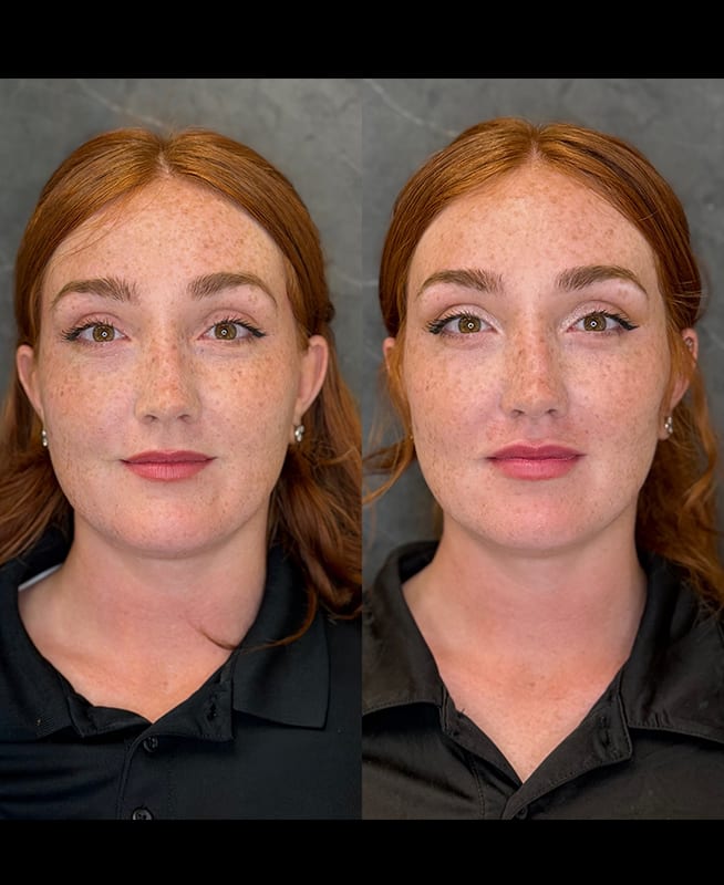lip filler ba 1