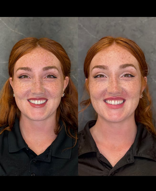 lip filler ba 2