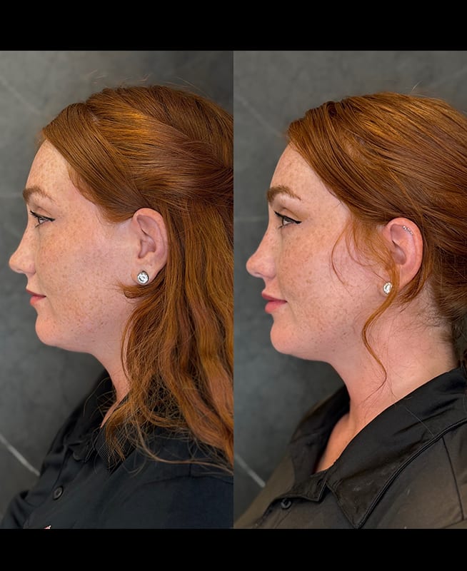lip filler ba 3