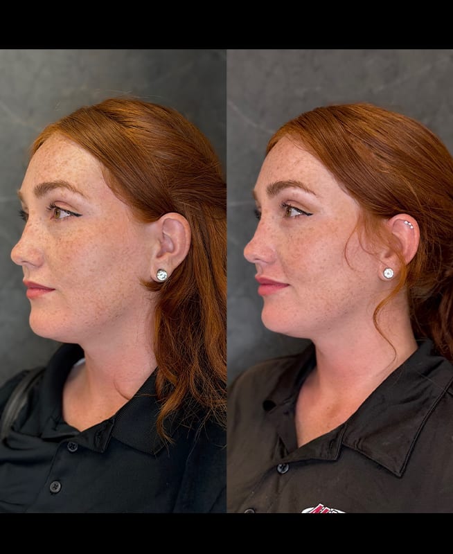 lip filler ba 4