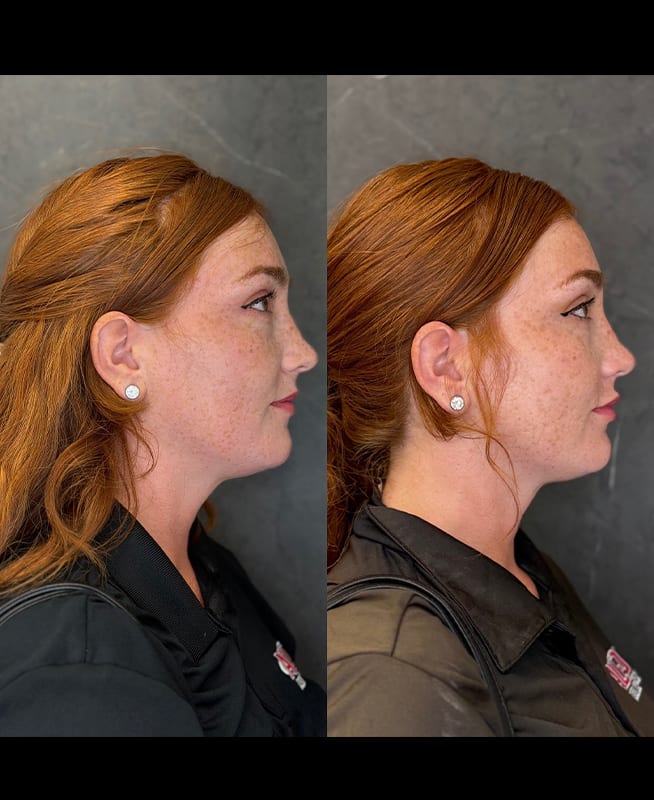lip filler ba 5