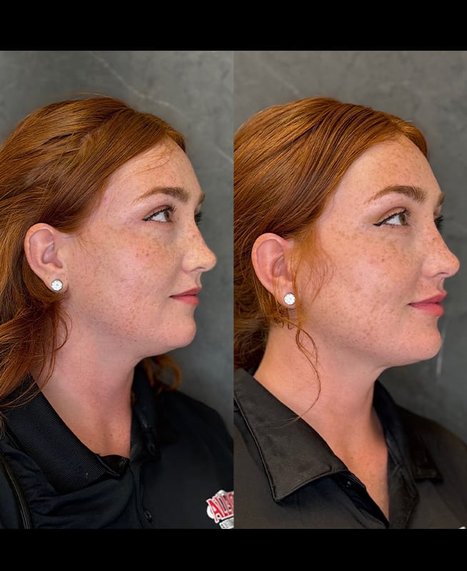 lip filler ba 6