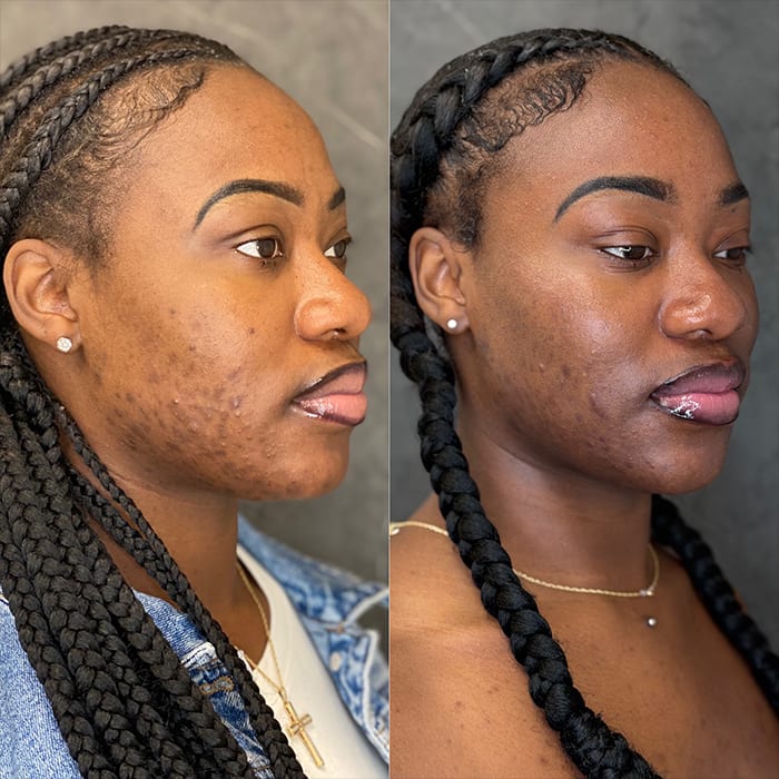 skinology chemical peels 2